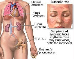 systemic lupus erythematosous clinical signs