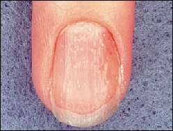 nails in psoriasic arthritis