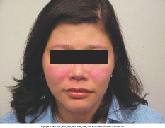 systemic lupus erythematosous rash