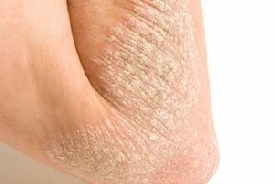 skin psoriasic arthritis